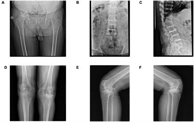 Ochronotic arthropathy effectively treated with total hip and total knee arthroplasty: a case report